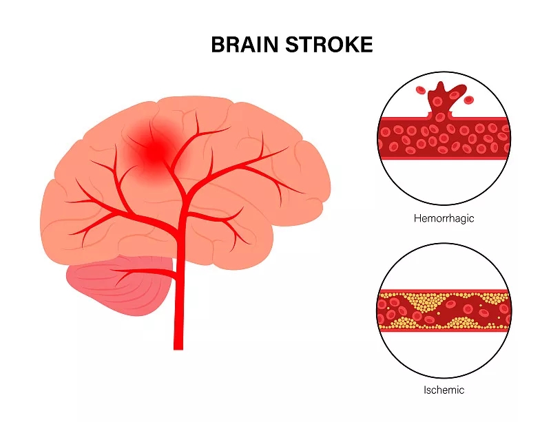 間充質(zhì)干細胞治療缺血性腦卒中之前應該了解哪些問(wèn)題