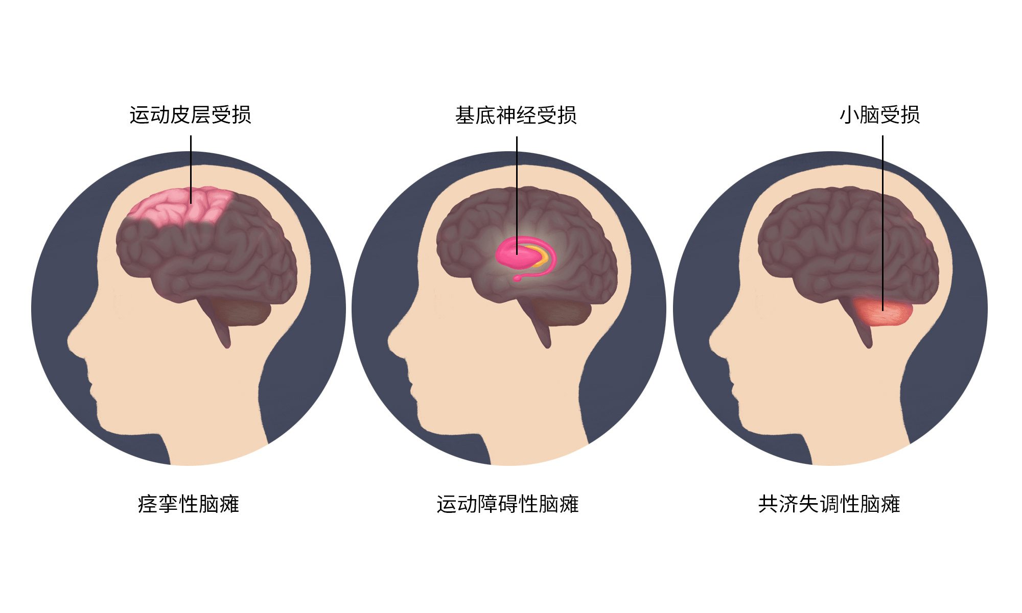 引起腦性癱瘓的大腦受損部位不同導致癥狀不同