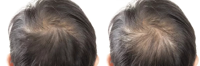 干細胞移植治療脫發(fā)可能改變頭發(fā)再生的未來(lái)