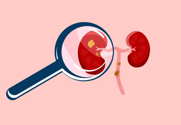 什么是急性腎損傷