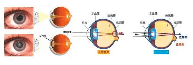 干細胞治療兒童白內障臨床案例