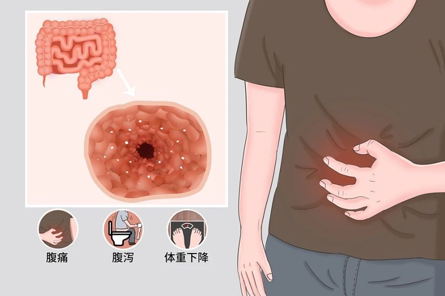 克羅恩的癥狀