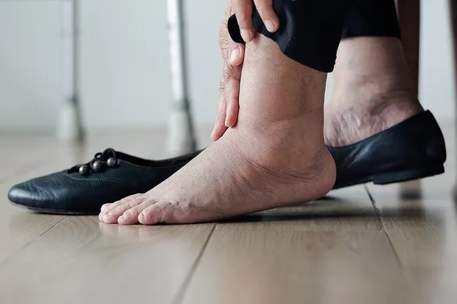 臉部和腳部腫脹