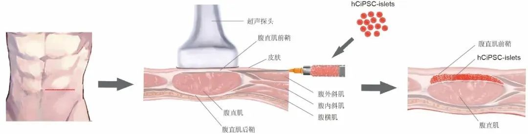 圖2:胰島細胞腹直肌前鞘下移植的示意圖 圖2:胰島細胞腹直肌前鞘下移植的示意圖