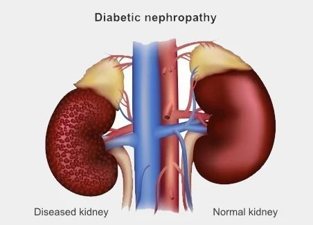 糖尿病腎病如何治療？干細胞療法為什么讓糖尿病腎病患者驚嘆？