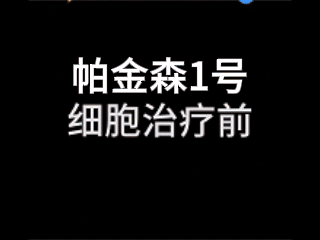 干細胞治療帕金森患者