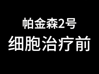 干細胞治療帕金森患者