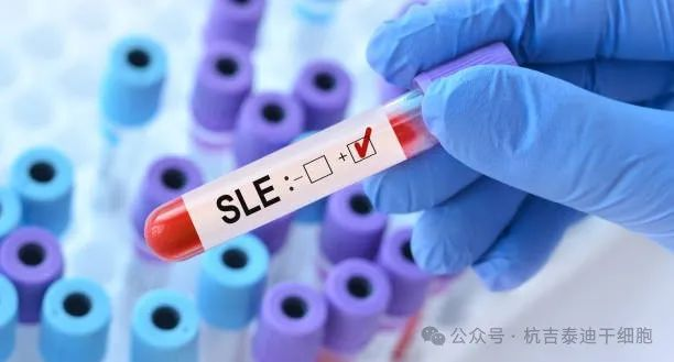 干細胞治療系統性紅斑狼瘡