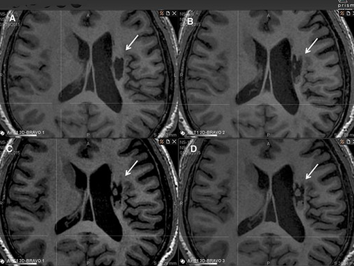 腔內組織生長(cháng)的縱向 MRI 示例