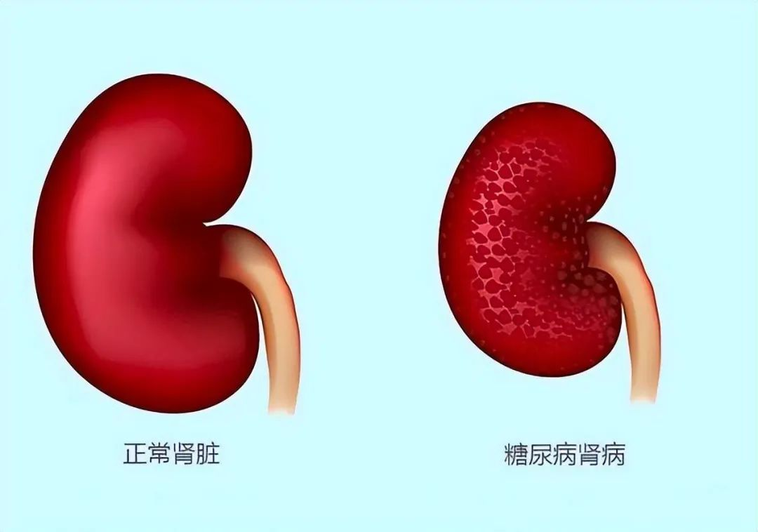 2025年1-12月干細胞治療糖尿病腎病的最新臨床進(jìn)展指南 2025年1-12月干細胞治療糖尿病腎病的最新臨床進(jìn)展指南