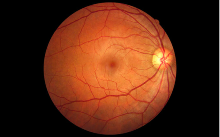 視神經(jīng)萎縮 視神經(jīng)萎縮